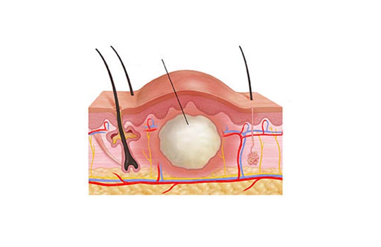 Skin-Subcutaneous Soft Tissue Surgical Diseases