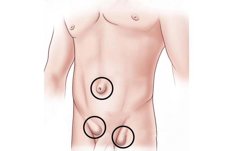 Abdominal Wall Hernias