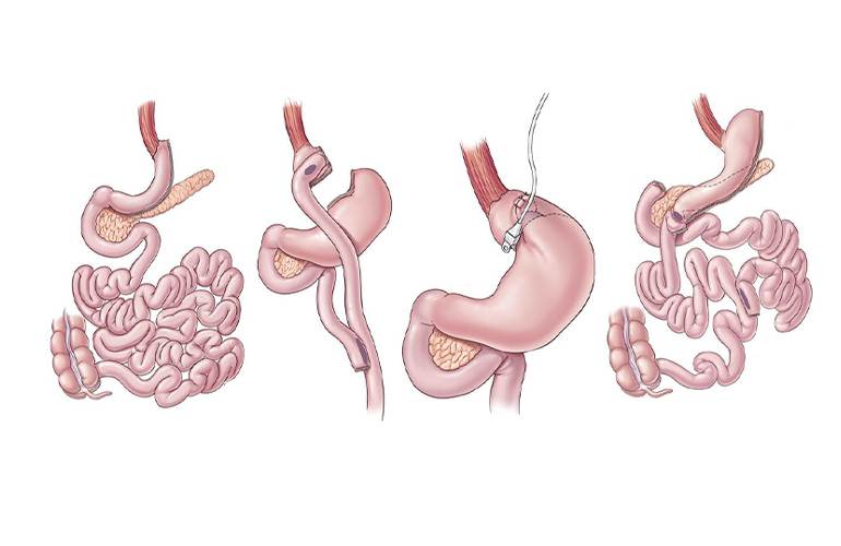 Bariatric and Metabolic Surgery