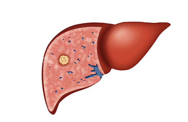 Liver Cancer