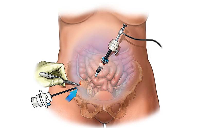 Laparoscopic Surgery