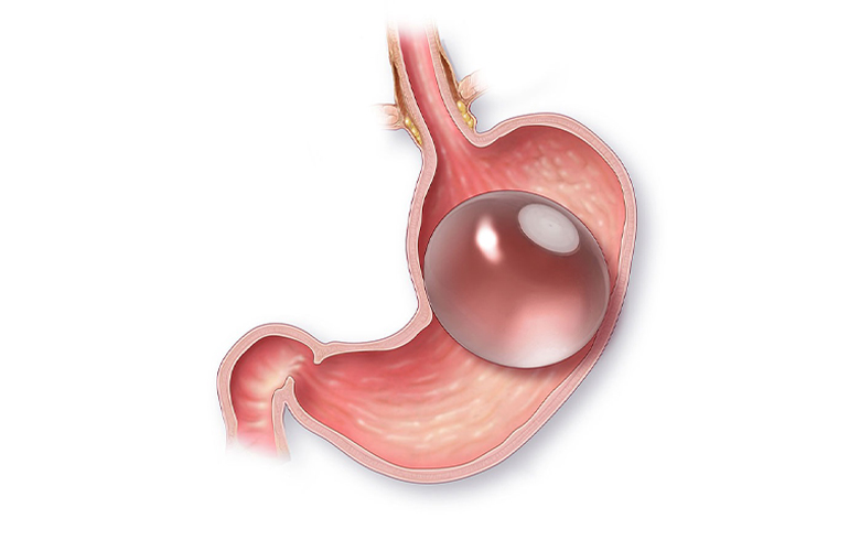 Gastric Balloon