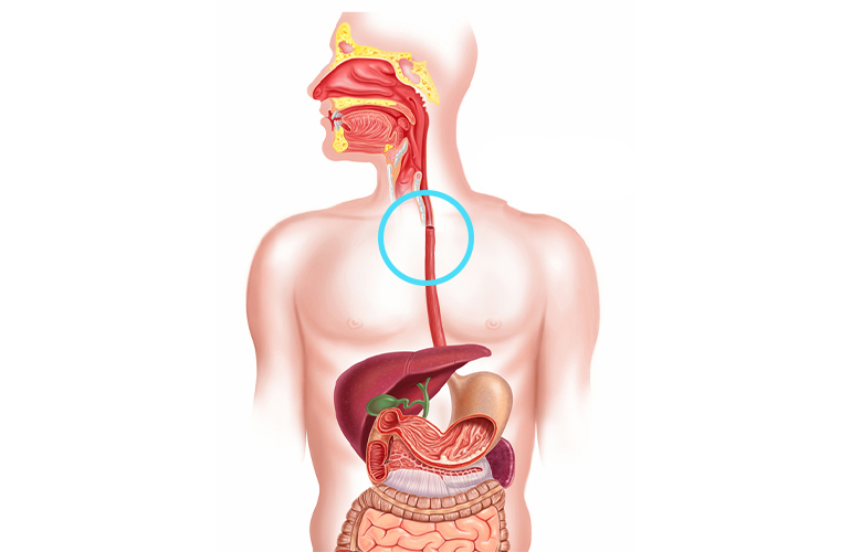 Esophageal cancer