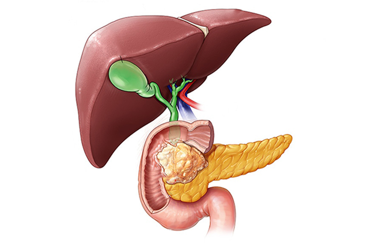 Pancreatic Cancer