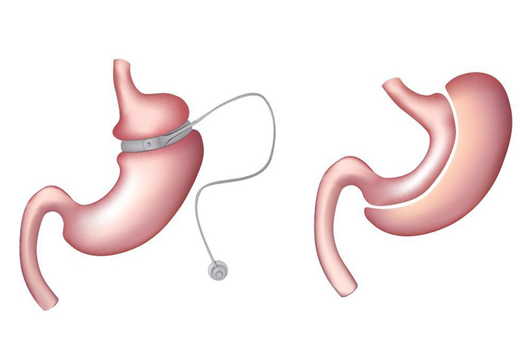 Revisional Bariatric Surgery