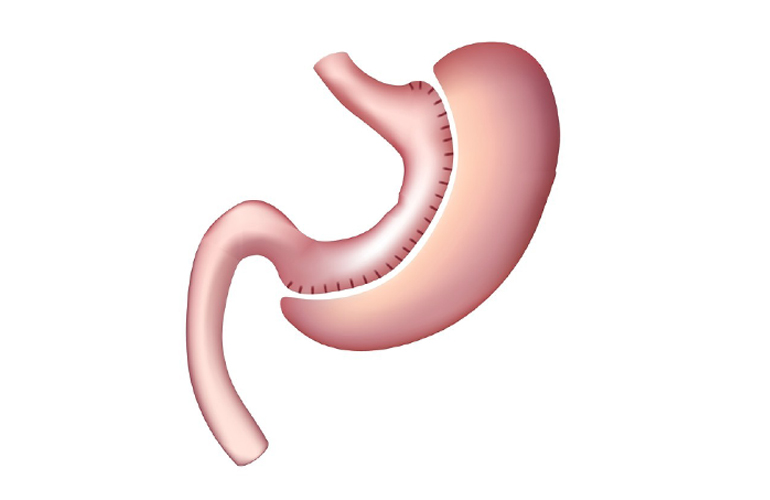 Sleeve Gastrectomy